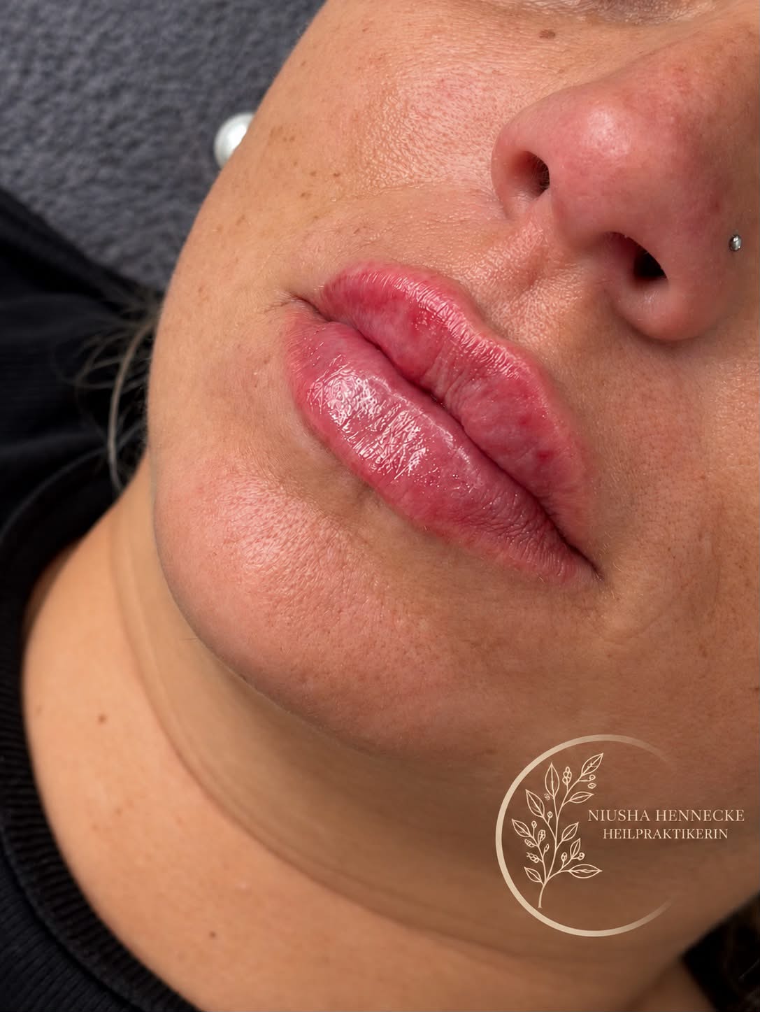Lippen nach einer ästhetischen Behandlung mit harmonischer Kontur