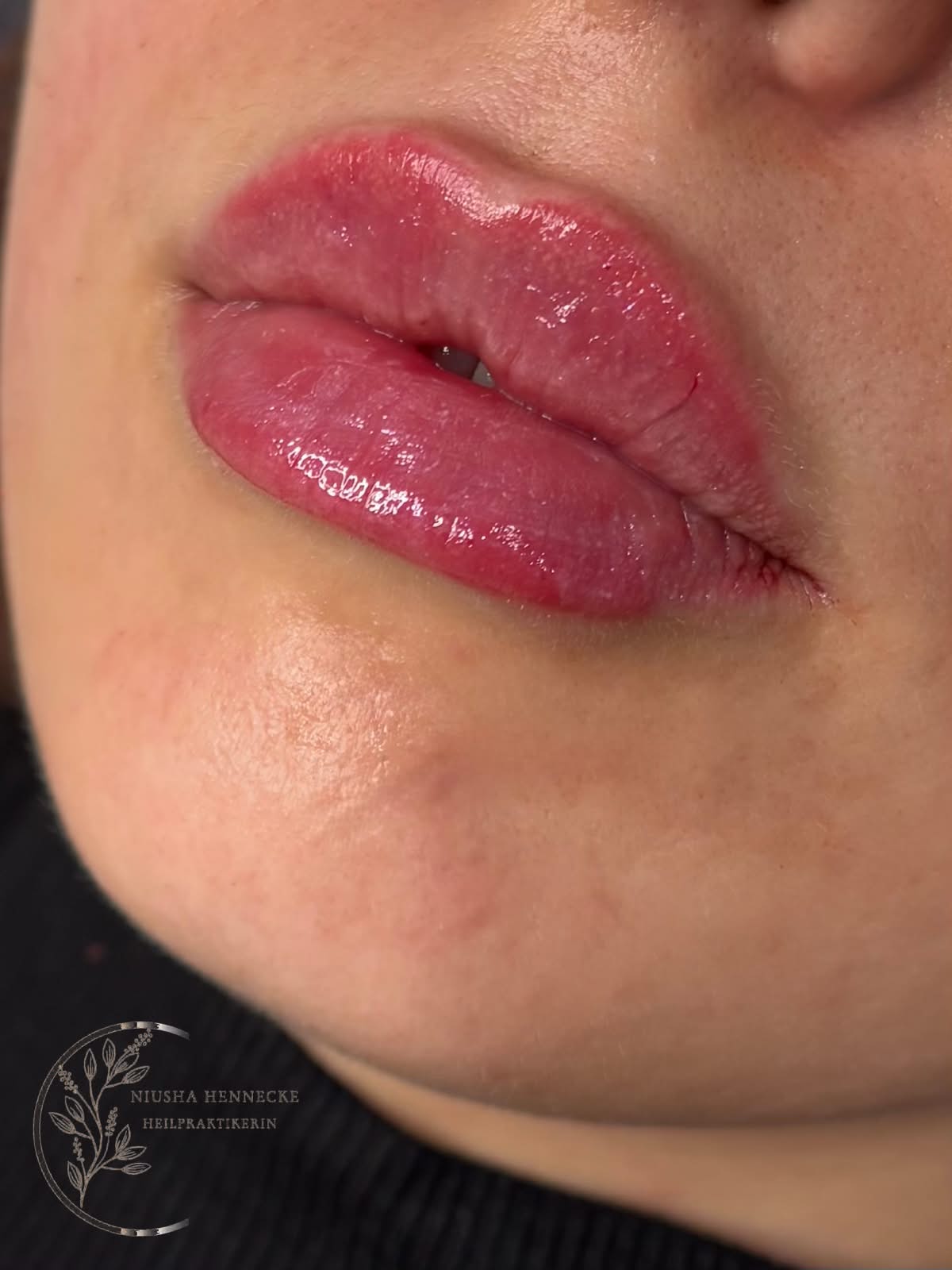 Lippen nach einer ästhetischen Behandlung mit gepflegtem Finish